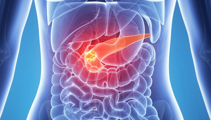 3d rendered illustration of the female anatomy - pancreas cancer