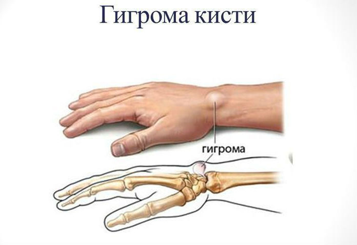 gigroma-kisti-2