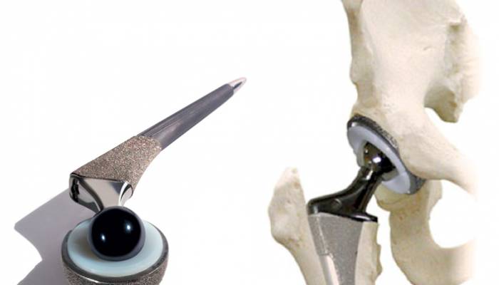 hip-arthroplasty