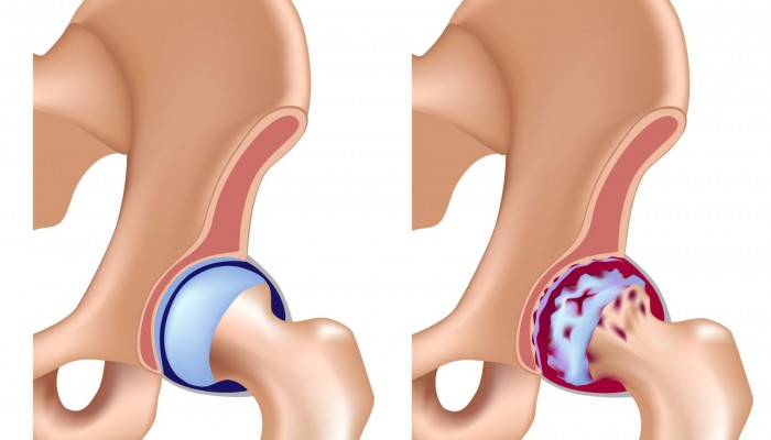 hip rheumatism