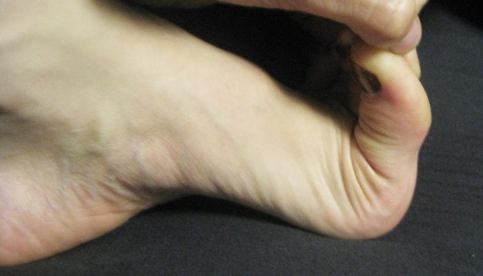 hypermobile-toe-eds