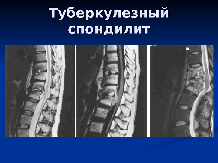 low_back_pain_2010_no_neck_70