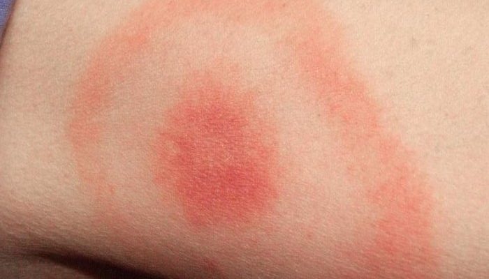 lyme-disease-9