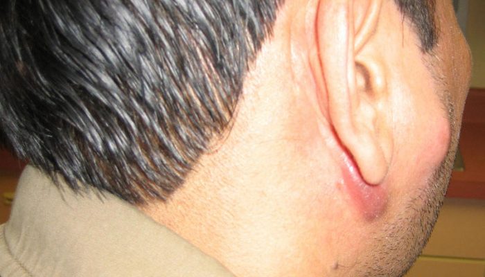 lymphadenitis-4