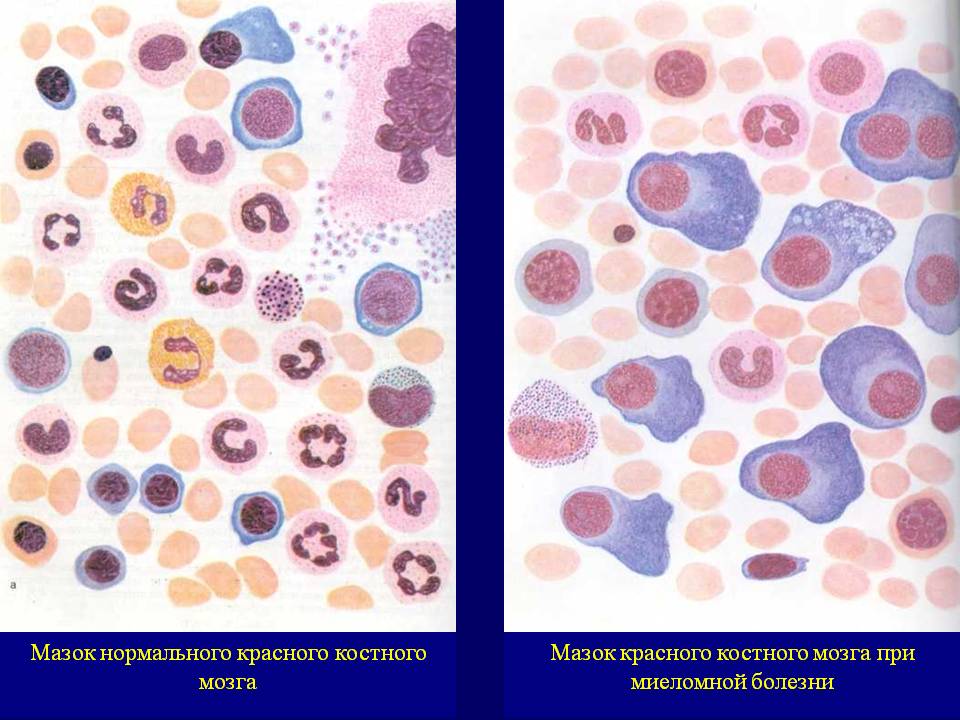 mielomnaya_bolezn_586