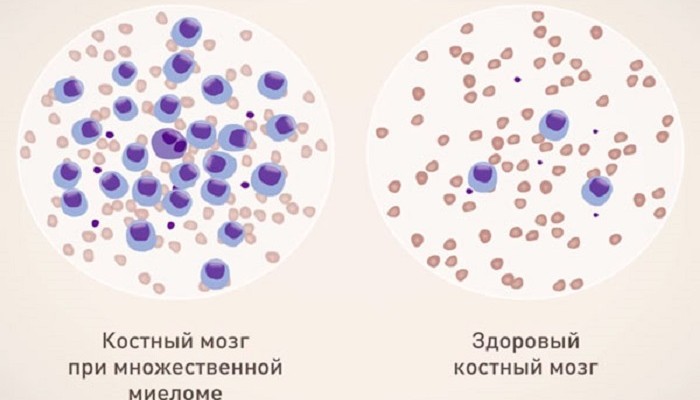mnozhestvennaja-mieloma
