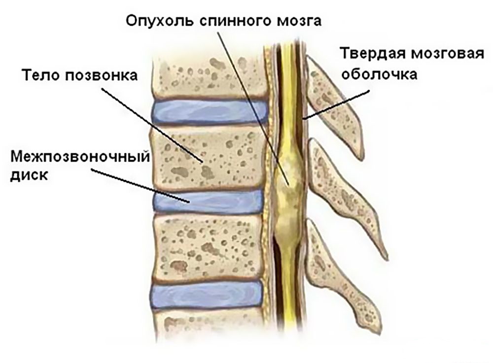 opukholi-spinnogo-mozga-i-pozvonochnika-u-detej1