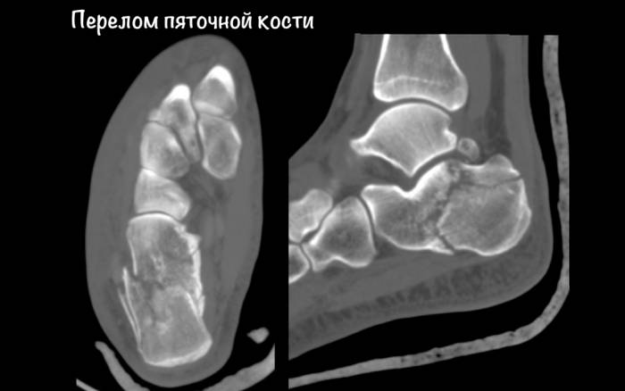 oskolchaty_perelom_piatochnoi_kosti_2