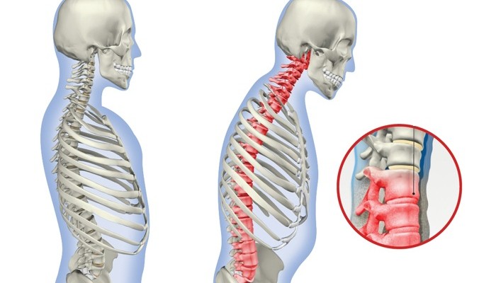osteo4