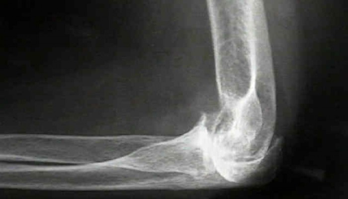 osteoarthritis_of_elbow