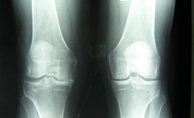 osteoartroz2