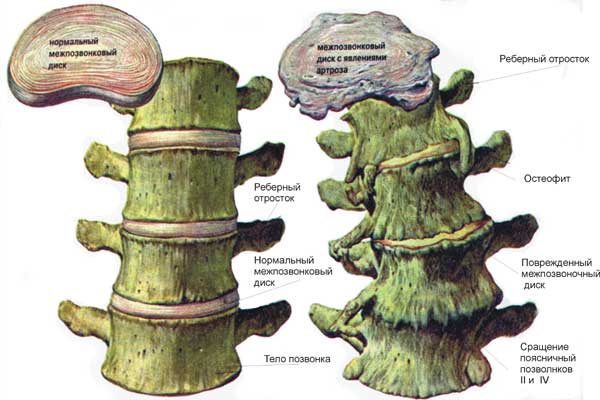 osteofity-pozvonochnika_5