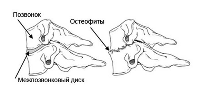 osteofity1-710x350