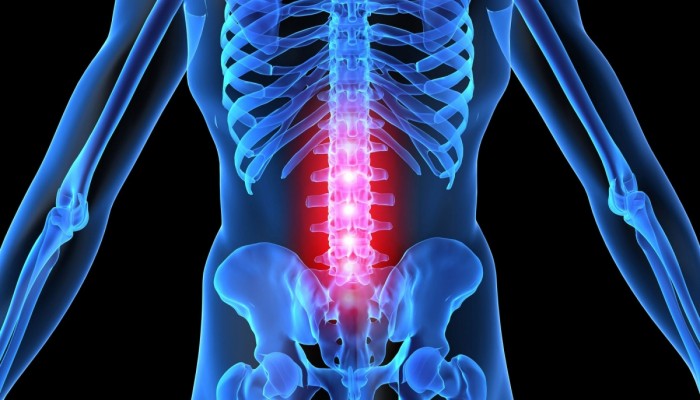 osteohondroz_poyasnichnogo_otdela_pozvonochnika