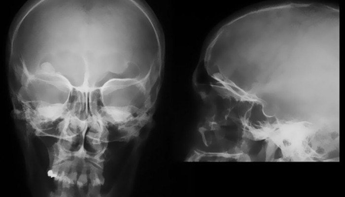 osteoma1