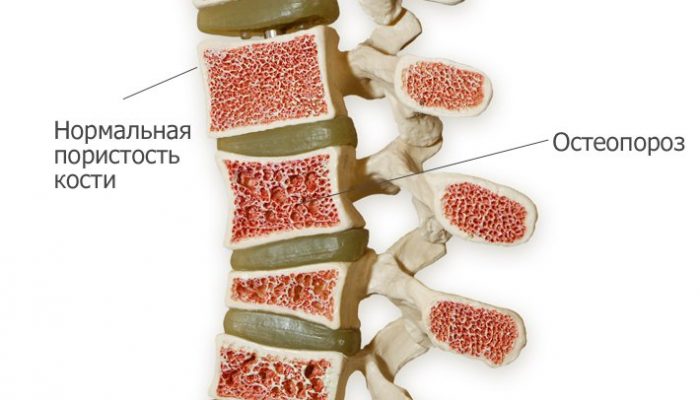 osteoporos