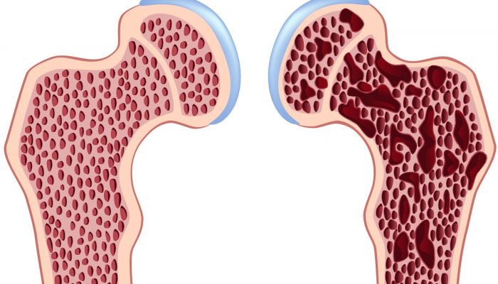 osteoporosis1