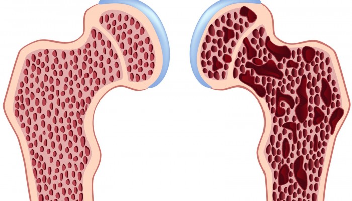 osteoporosis(1)