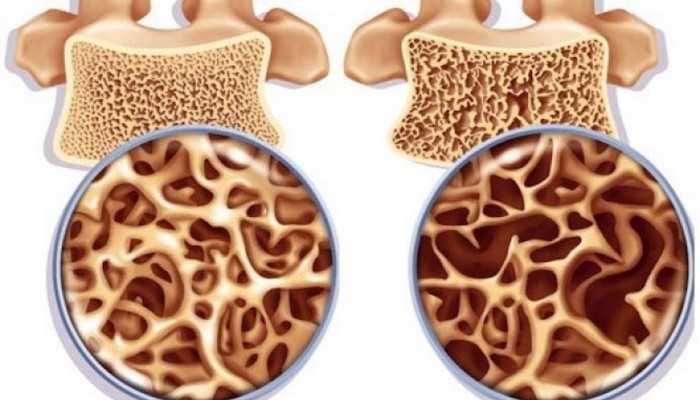 osteoporoz-3