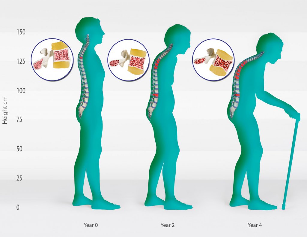 osteoporoz1