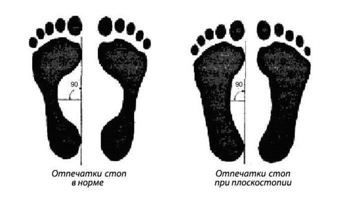 ploskostopie2