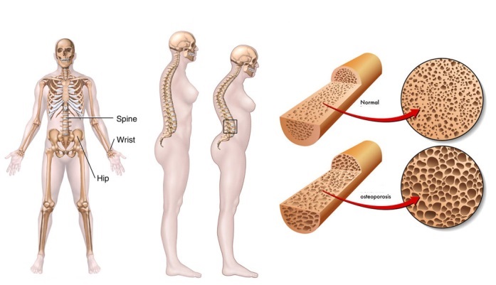 prichiny-vozniknovenija-osteoporoza-u-zhenshhin_2