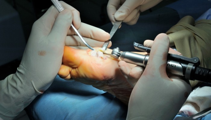 provedenie-operacii-pri-shishke-na-bolyshom-palyce-nogi