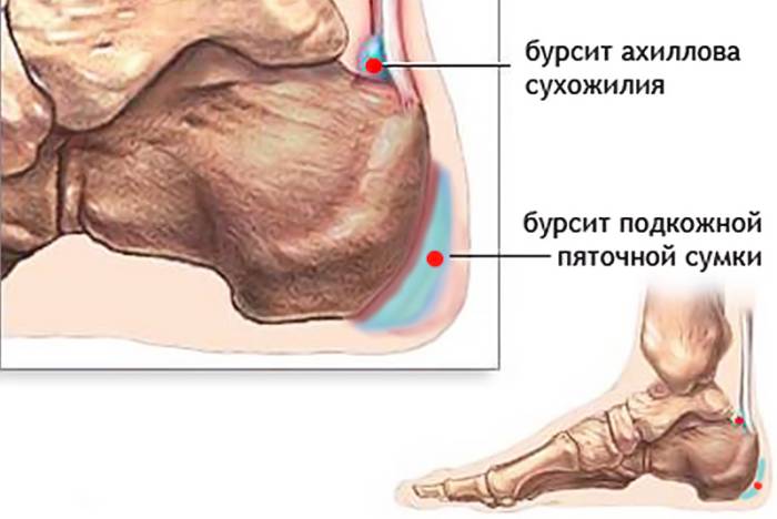 pyatochnyiy-bursit