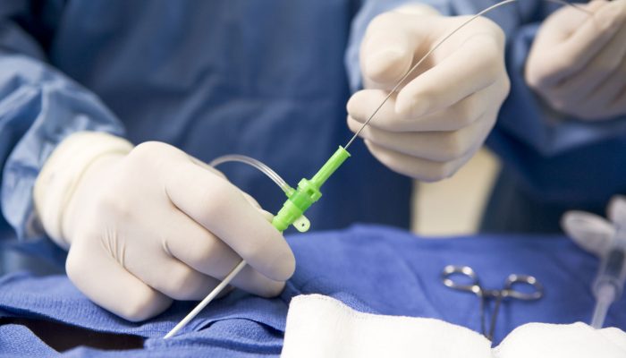 radiochastotnaya-ablyaciya-serdca-otzyvy-pacientov