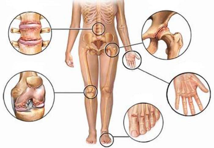 revmatoeidis-arthritida