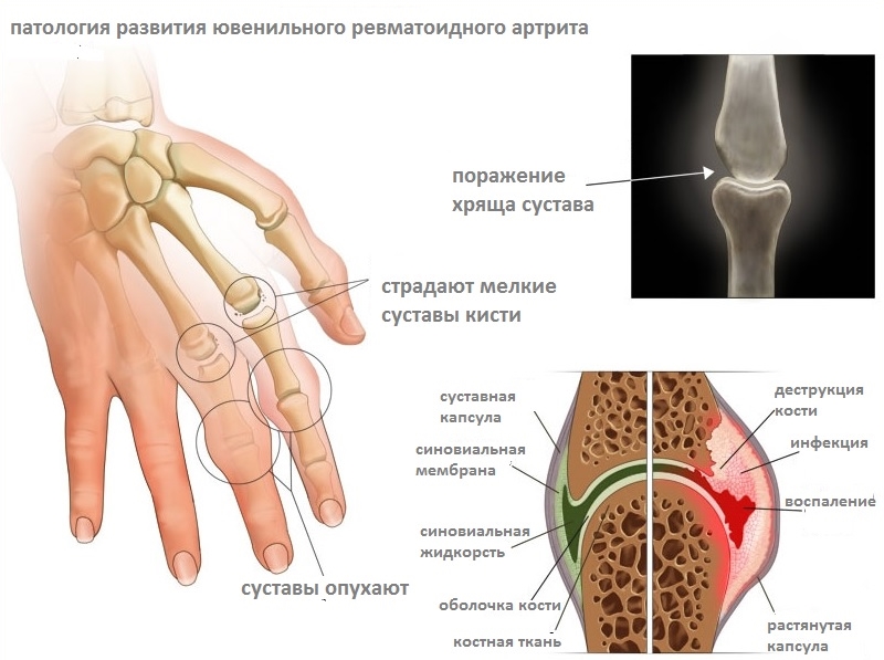 revmatoidnyj-artrit-3
