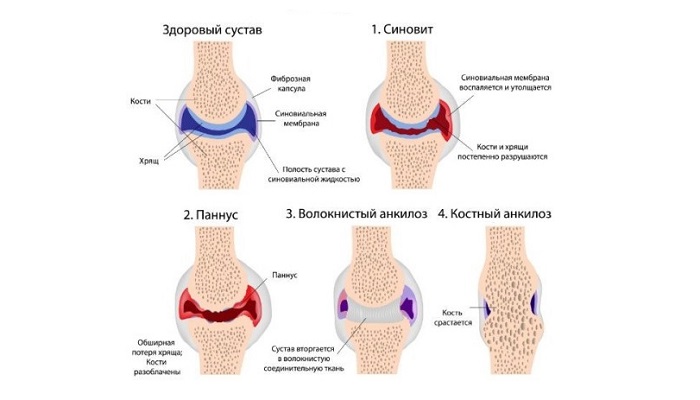 revmatoidnyy_artrit_10-500x463