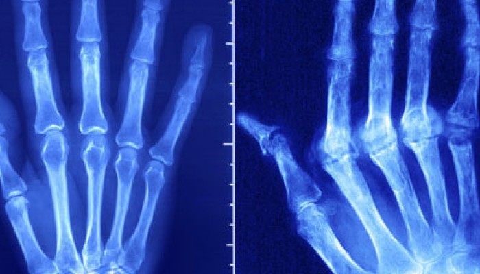 rheumatoid-arthritis-1728x800_c