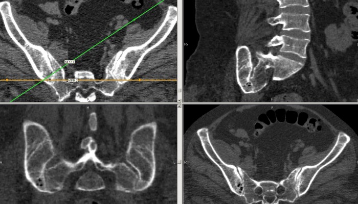 sacroileitis_SKV_CT