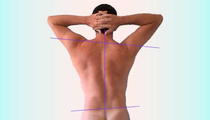scoliosis-копия-1728x800_c