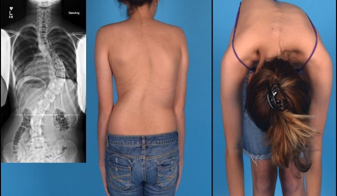 scoliosis_1