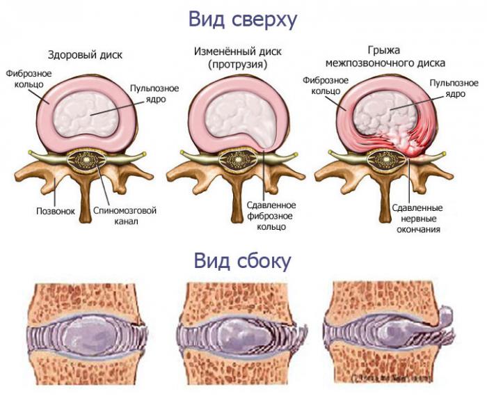 simptomi-protruzii-pozvonochnika-poyasnichnogo-otdela