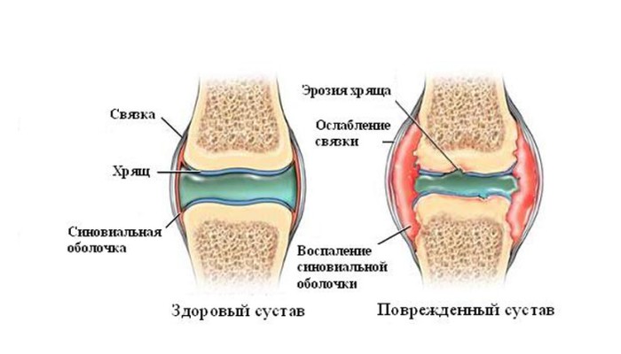 sirovatka-krovi-i-sinovialnaya-gidkost-pri-artritah