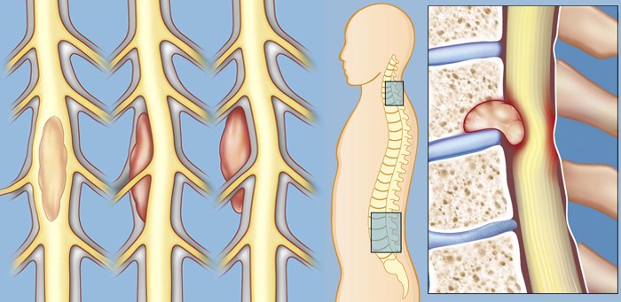 spinal-tumors