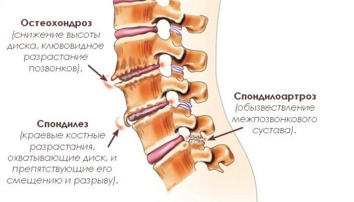 spondilez