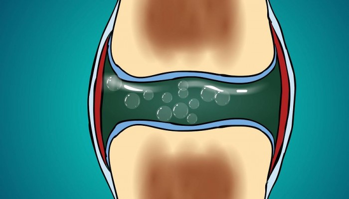 synovial-fluid-cavitation