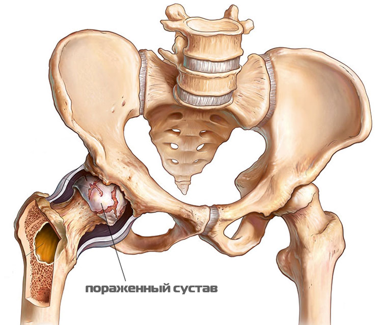 tazobedrennyy-sustav-porazhennyy-artritom
