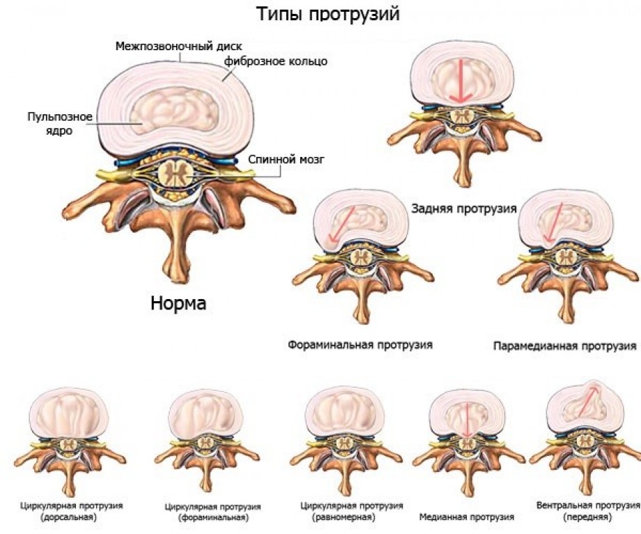 tipy-protruzij