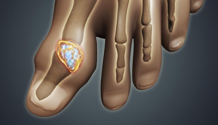 treat-gout-home_889094a908353d0e