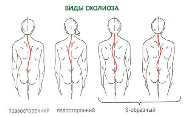 vidy_skolioza