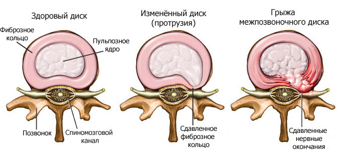 vozniknoveniya-grizhi-pozvonochnika