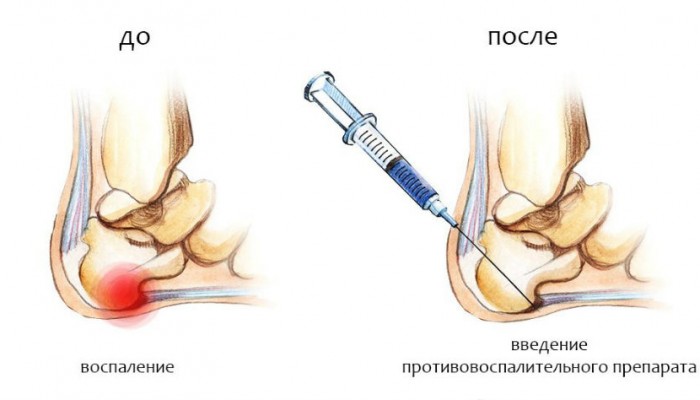 vylechit-pyat-shpor-4