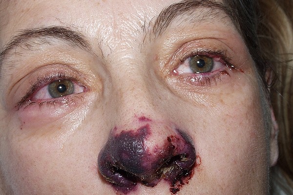 wegener_granulomatosis08